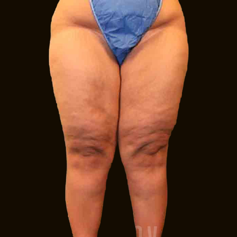 Case--1299 | Before Body