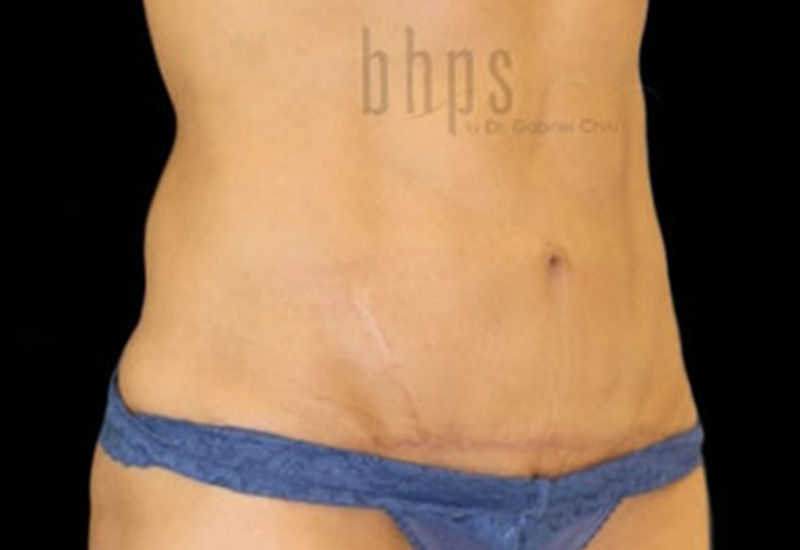Case--2545 | After Abdominoplasty 2