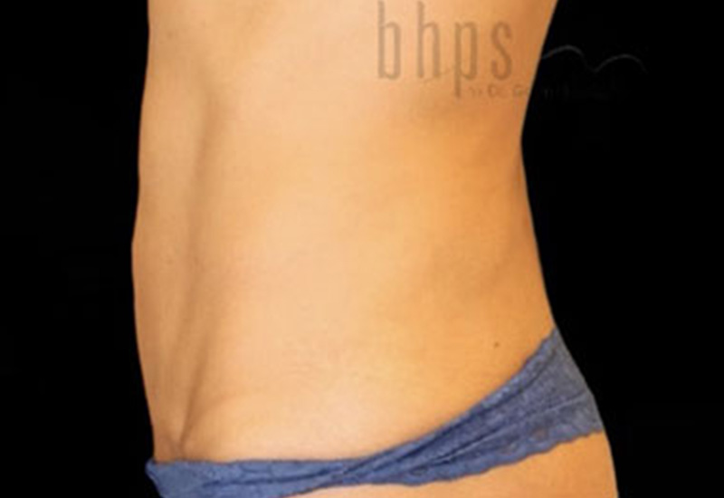 Case--2545 | After Abdominoplasty 3