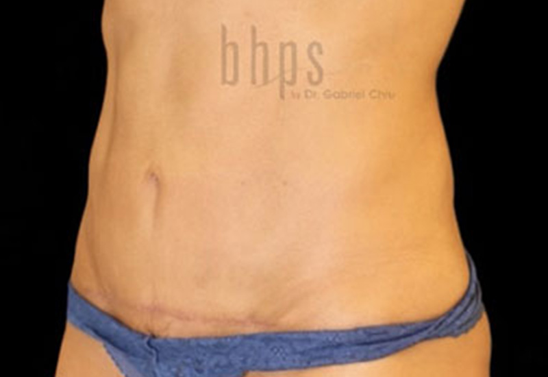 Case--2545 | After Abdominoplasty 4