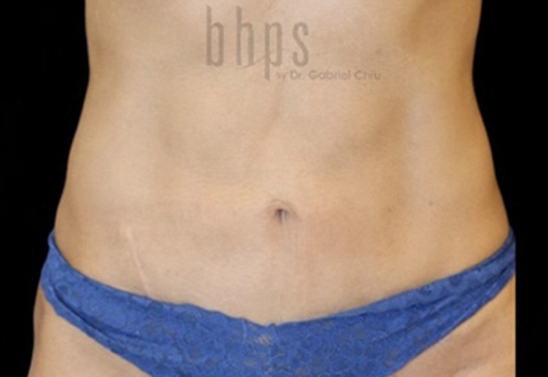 Case--2545 | After Abdominoplasty