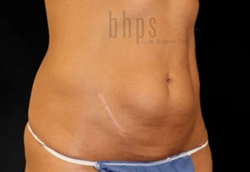 Case--2545 | Before Abdominoplasty 2