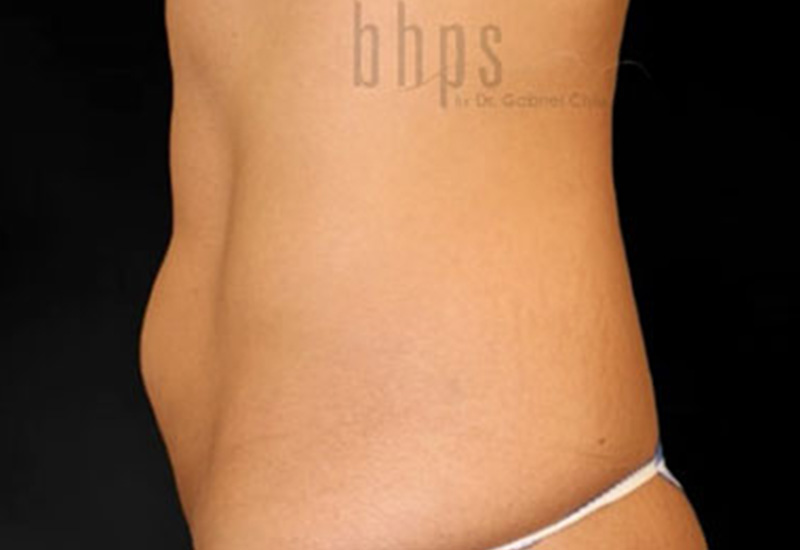 Case--2545 | Before Abdominoplasty 3