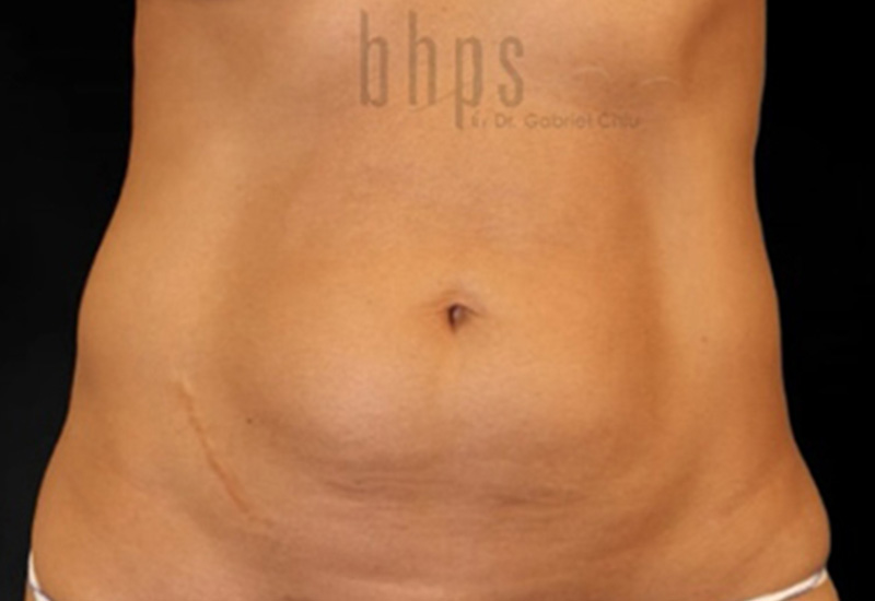 Case--2545 | Before Abdominoplasty