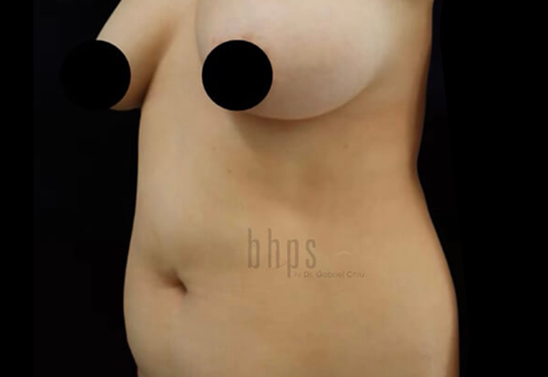 Case--1596 | Before Abdominoplasty 2