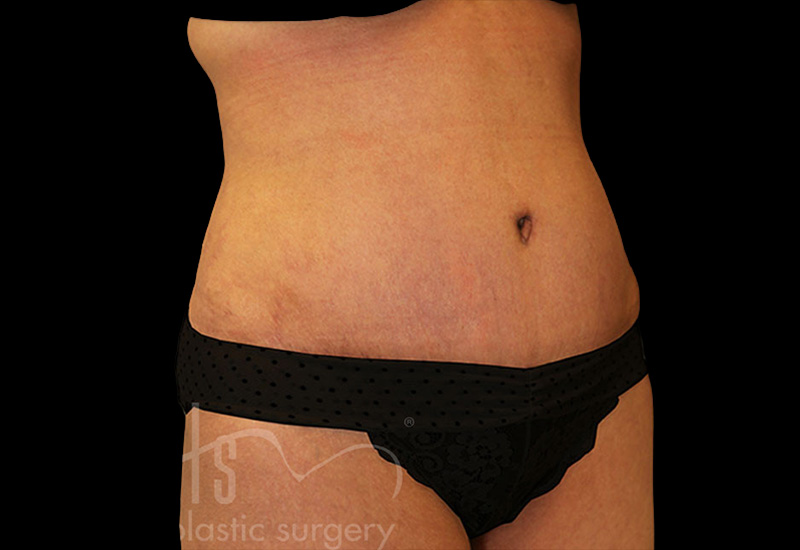 Case--3448 | After Abdominoplasty 2