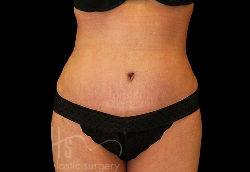 Case--3448 | After Abdominoplasty