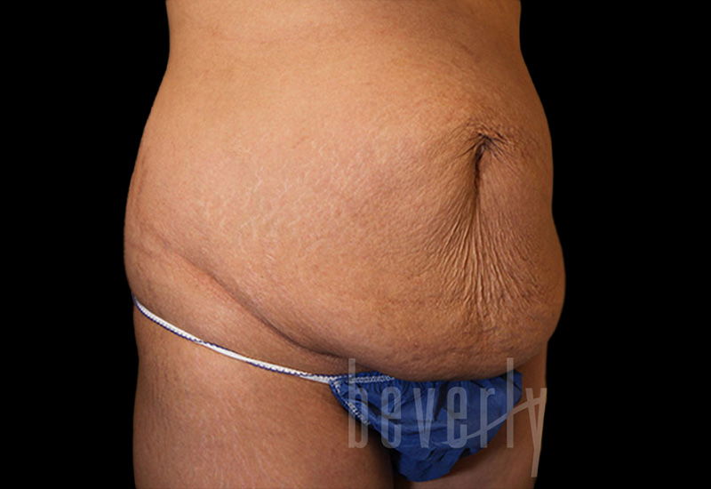 Case--3448 | Before Abdominoplasty 2