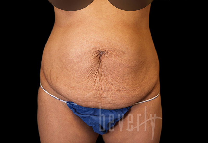 Case--3448 | Before Abdominoplasty