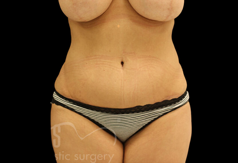 Case--8119 | After Abdominoplasty