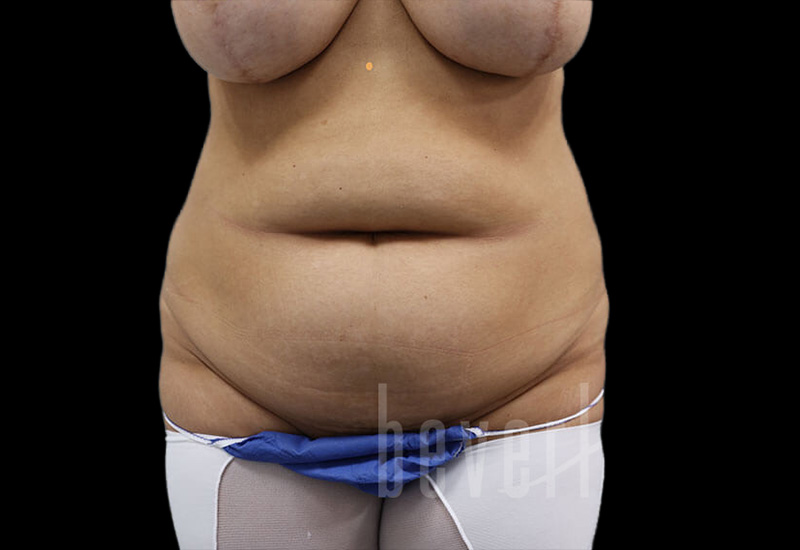 Case--8119 | Before Abdominoplasty