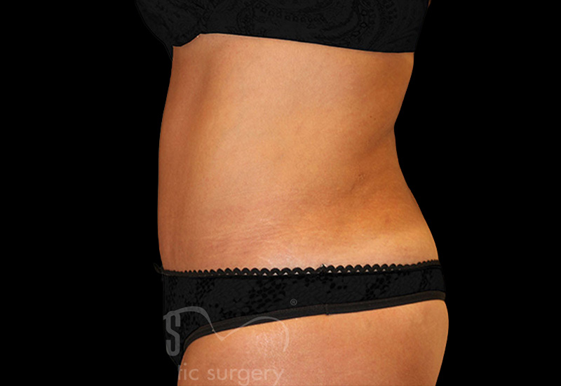 Case--4479 | After Abdominoplasty 2
