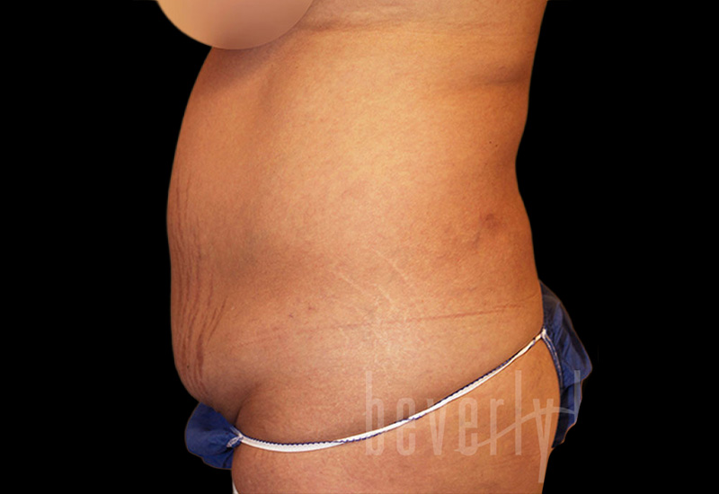 Case--4479 | Before Abdominoplasty 2