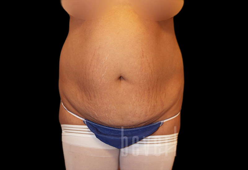 Case--4479 | Before Body