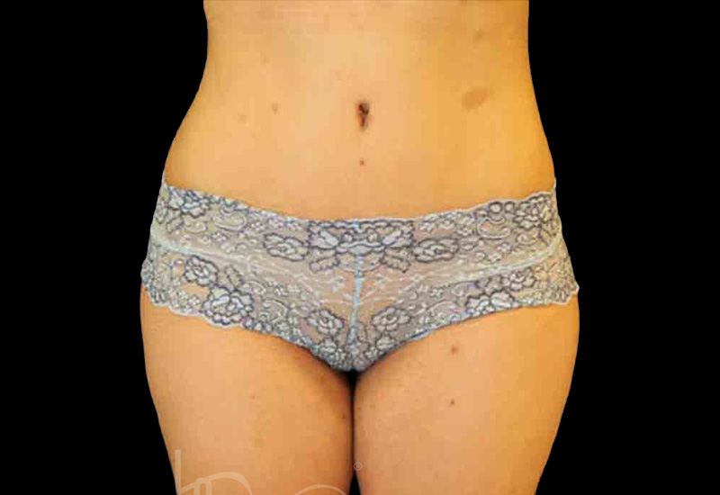 Case--8393 | After Body