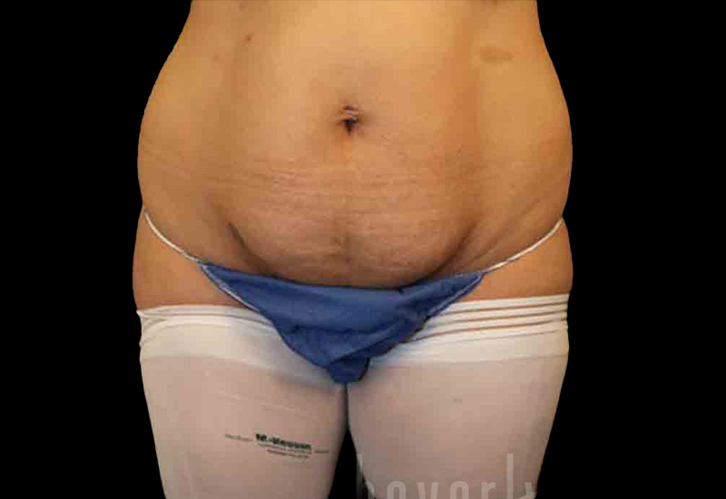 Case--8393 | Before Body