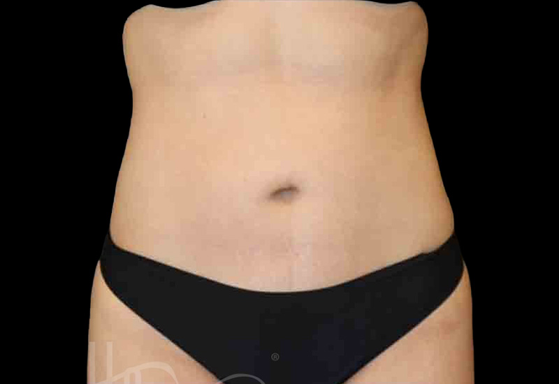 Case--3857 | After Body