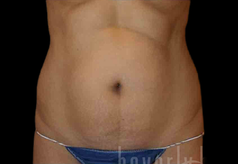 Case--3857 | Before Body