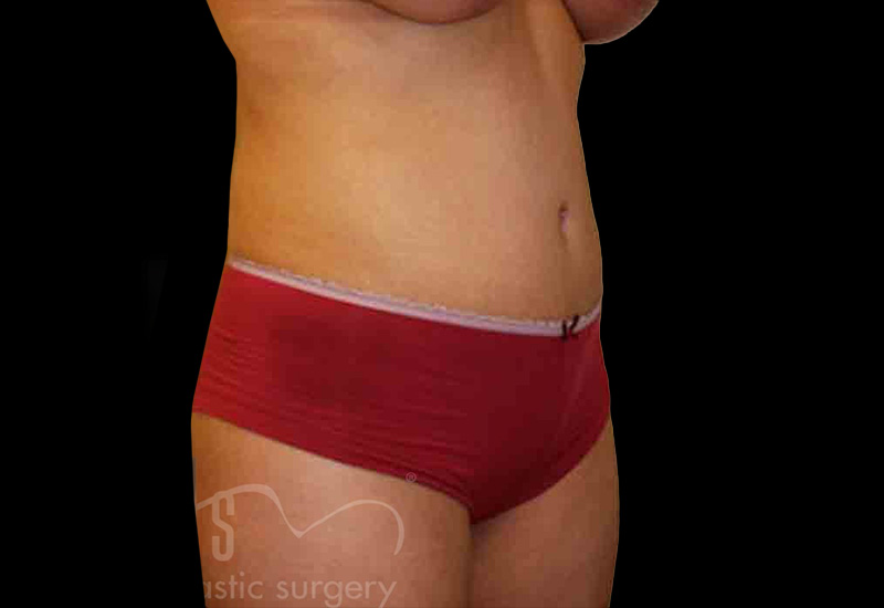 Case--9147 | After Body