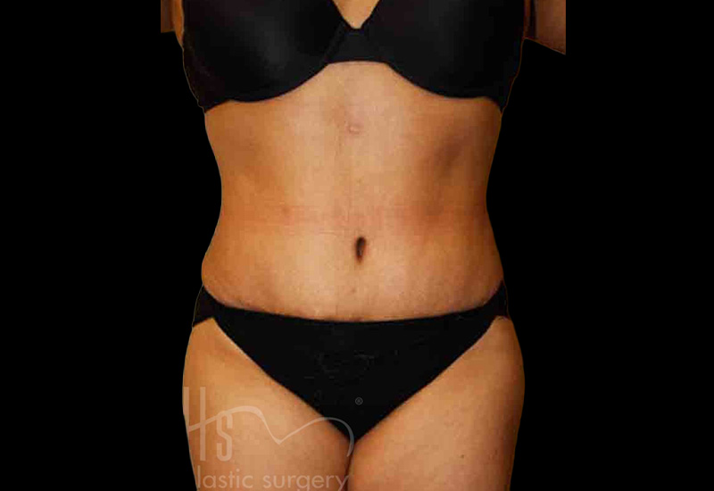 Case--6215 | After Body