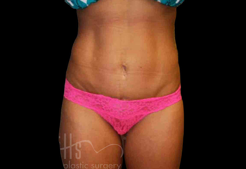 Case--2195 | After Body