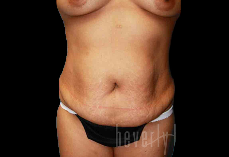 Case--6215 | Before Body