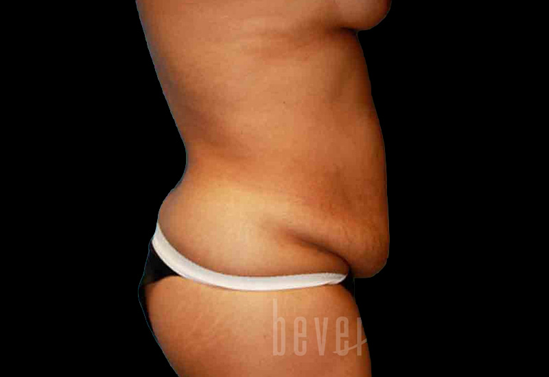 Case--6215 | Before Abdominoplasty 2