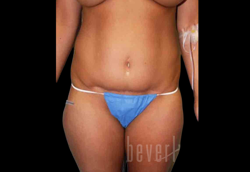 Case--2195 | Before Body