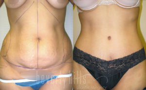 Tummy Tuck Patient 26 Before & After - Thumbnail