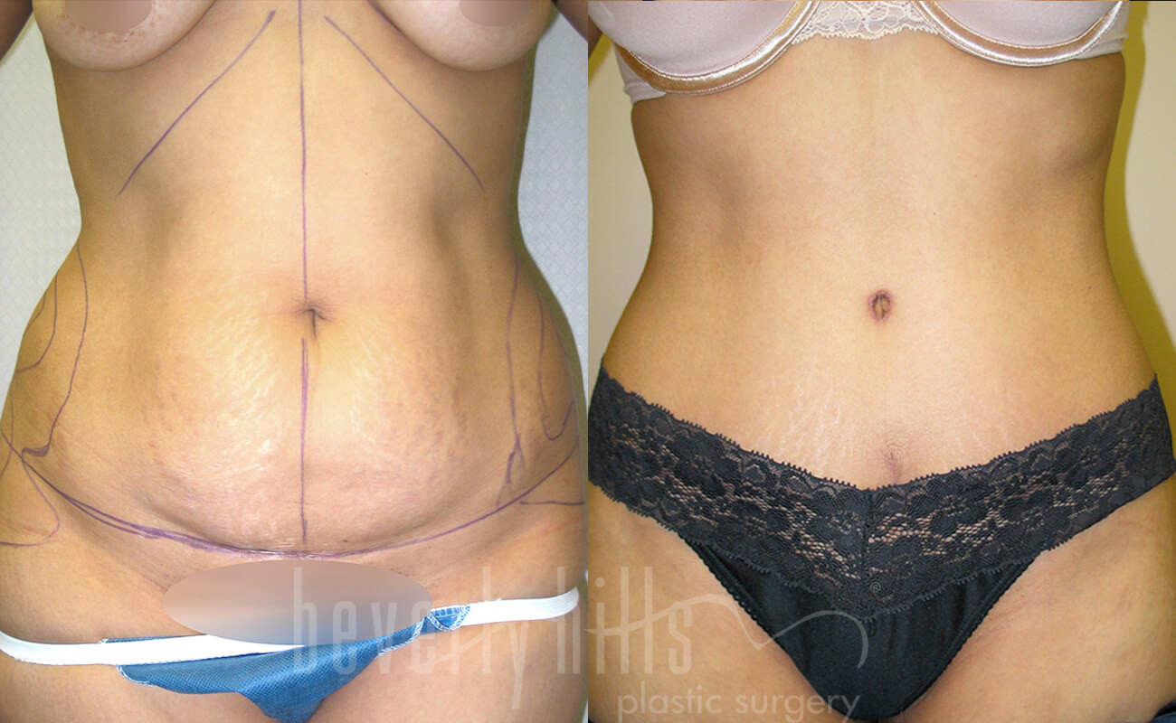 Tummy Tuck Patient 26 Before & After