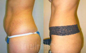Tummy Tuck Patient 26 Before & After - Thumbnail