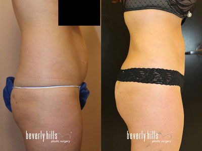 Liposuction-120938b