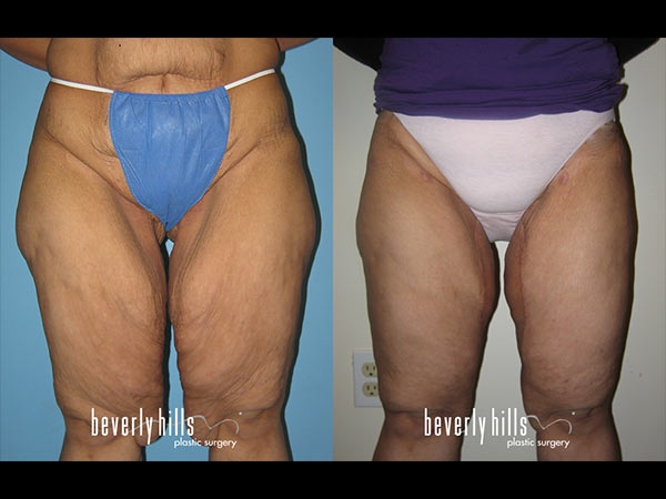 thigh-lift-1423217890