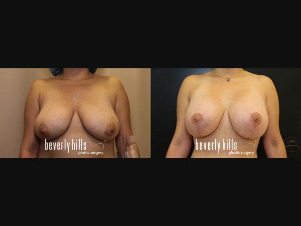 breast-02042015-01