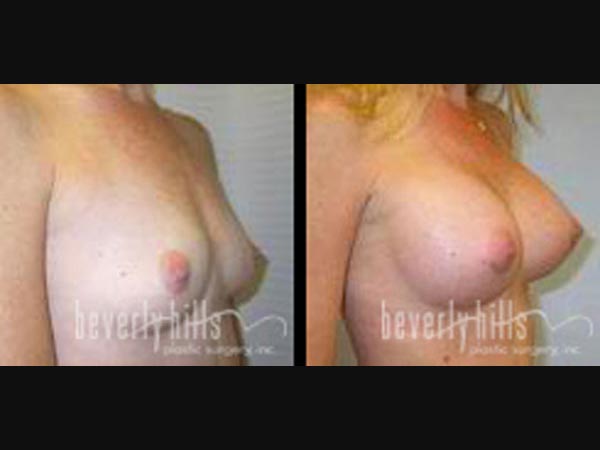 breast-1-1