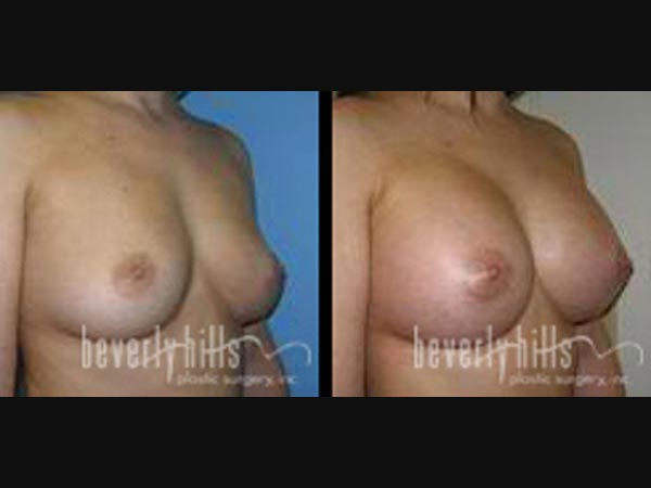 breast-1-3
