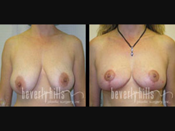 breast-21-21