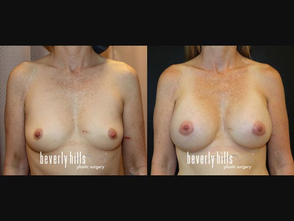breast-aug-312908
