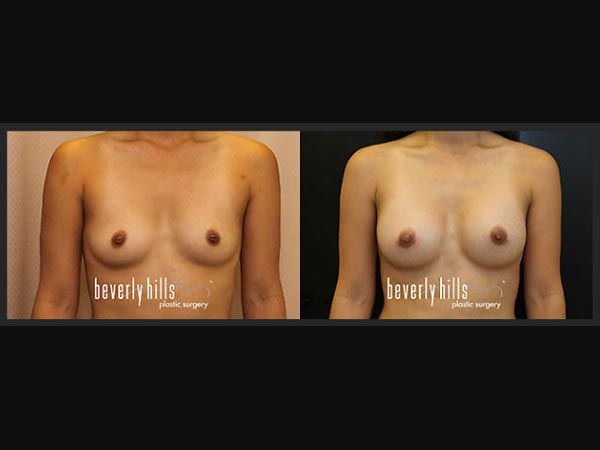 Before and after female breast augmentation example #5
