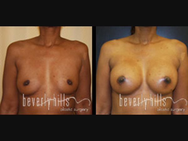 breast25-3