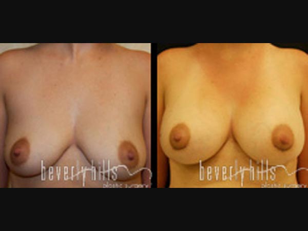 breast27-21