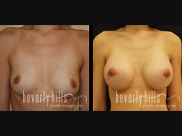 breast_16-3