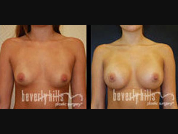 breast_30_2