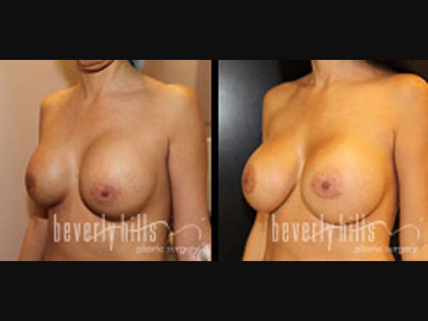 breast_31_3