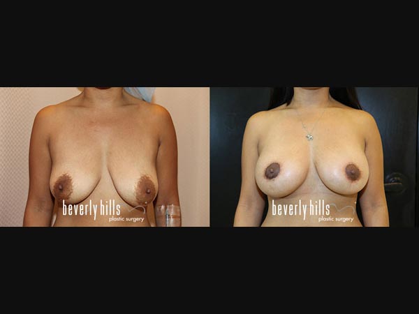 breast_new-01a14