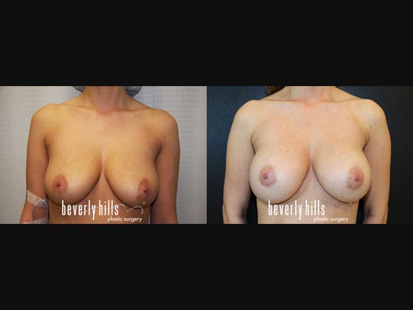 breast_new-03a69