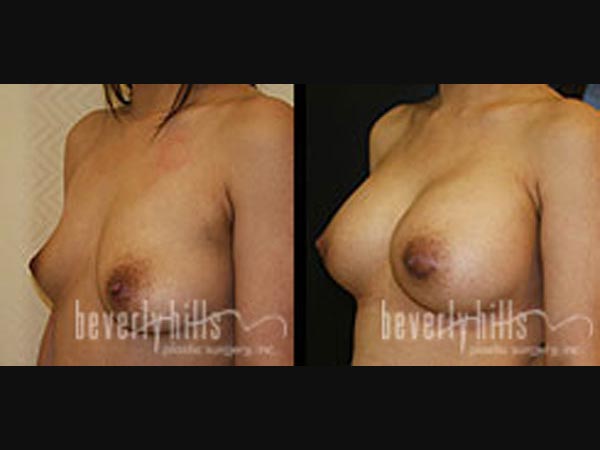 breast_page9_3
